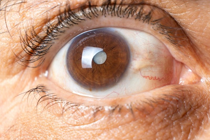 Cataract Treatment in Leesburg, Clermont & Eustis Fishman & Sheridan
